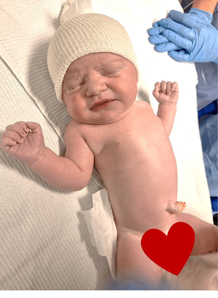 Här är navelsträngen klippt och Clary-Mei har fått en liten mössa – gjord av en knästrumpa haha!